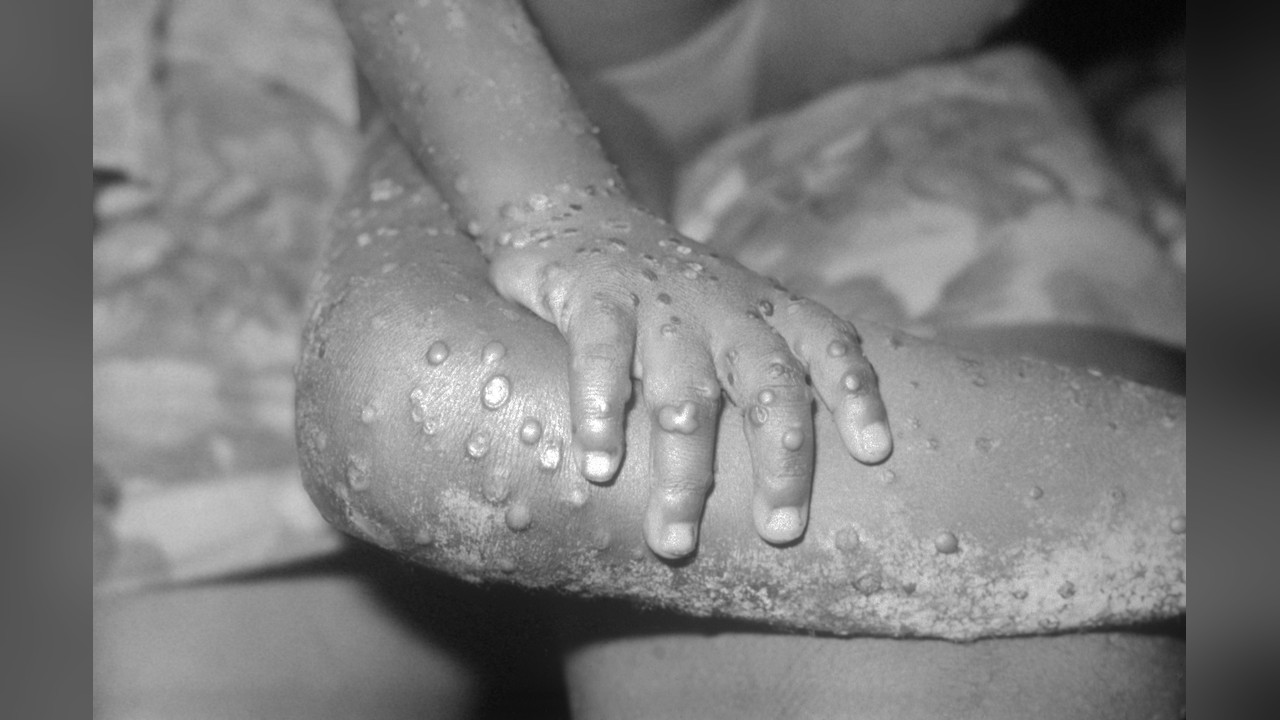 Analysis: Mpox